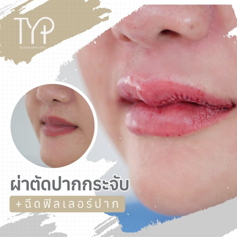ปากกระจับ และ ฟิลเลอร์ปาก