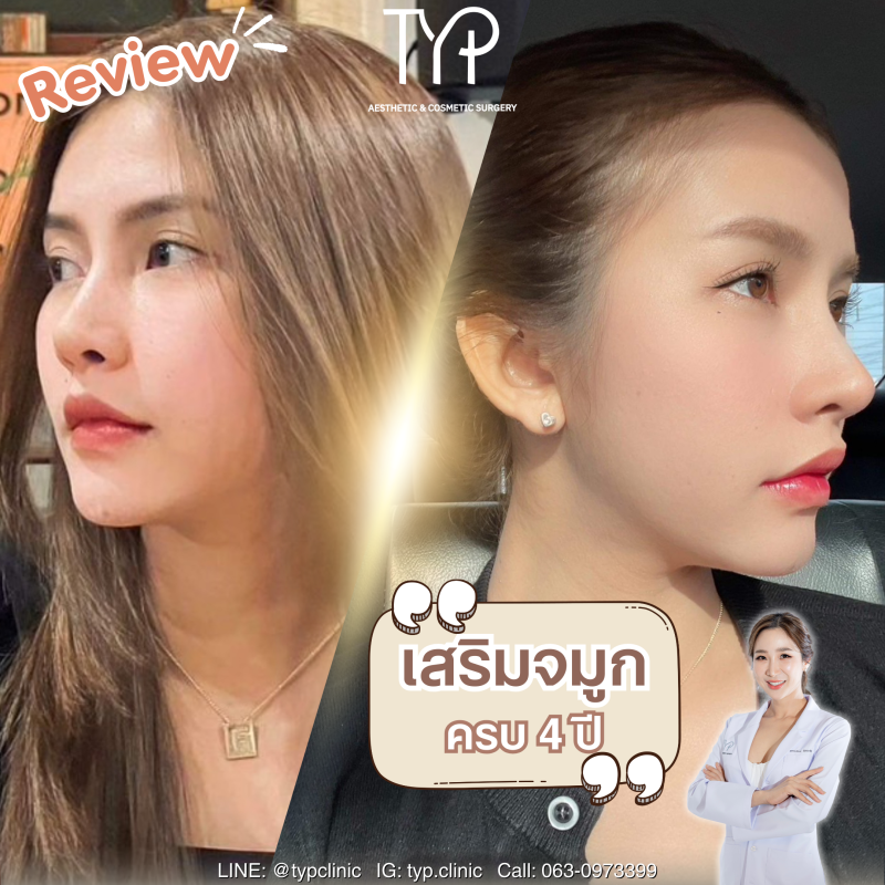 nose surgery typ hatyai after 4 year no.2
