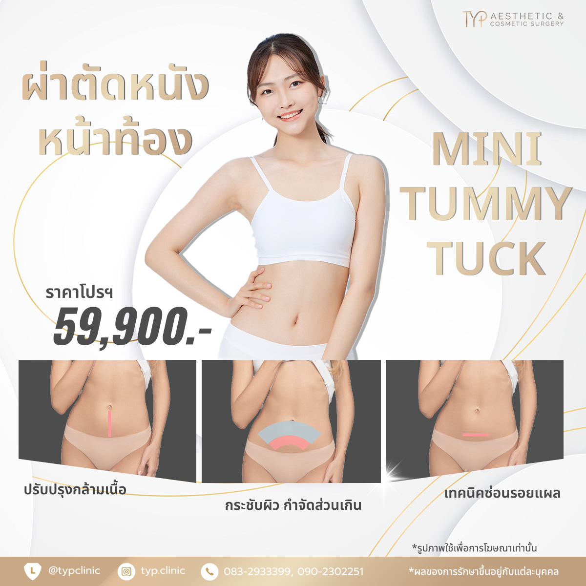 หน้าท้องแตกลาย